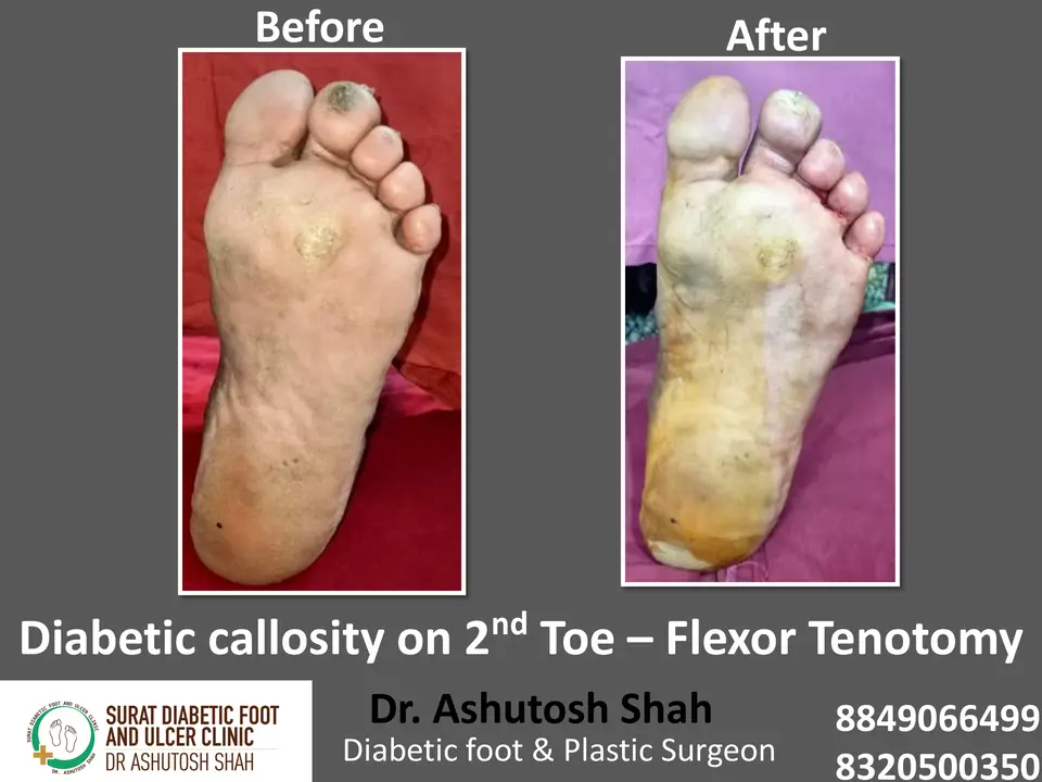 Diabetic Foot  PPT sunita.pptx-48.webp